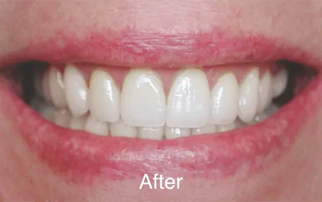 dental before and after - Buckeye Pediatric Dentistry in Reynoldsburg
