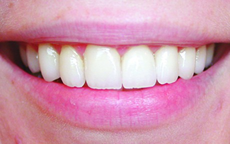 dental before and after photo - Buckeye Pediatric Dentistry in Reynoldsburg