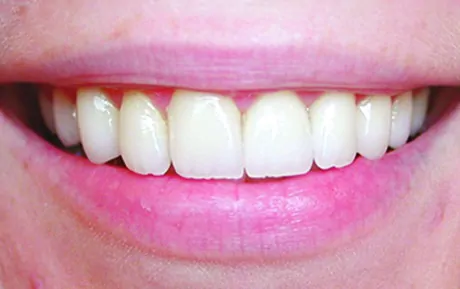 dental before and after photo - Buckeye Pediatric Dentistry in Reynoldsburg