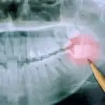 wisdom teeth - Buckeye Pediatric Dentistry in Reynoldsburg